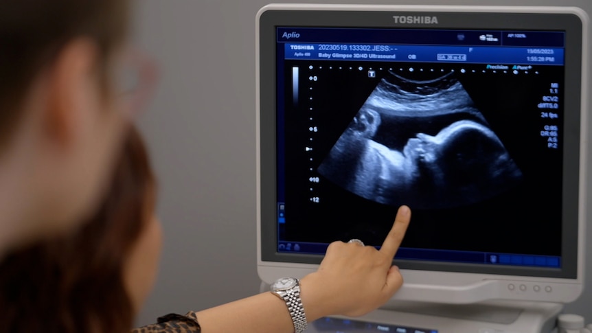 A screen shows a 3D ultrasound image of a baby's head
