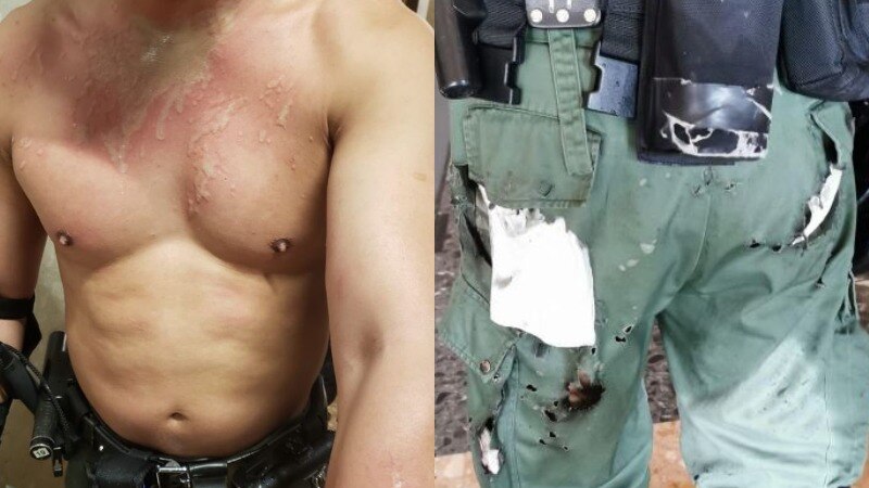a composite image of a shirtless man with burns and blistering to his torso and arms and a police officer's burnt uniform.
