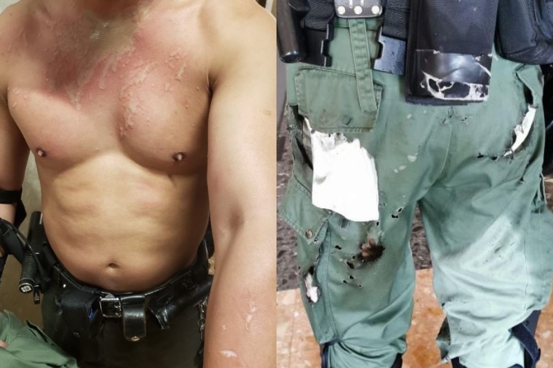 a composite image of a shirtless man with burns and blistering to his torso and arms and a police officer's burnt uniform.