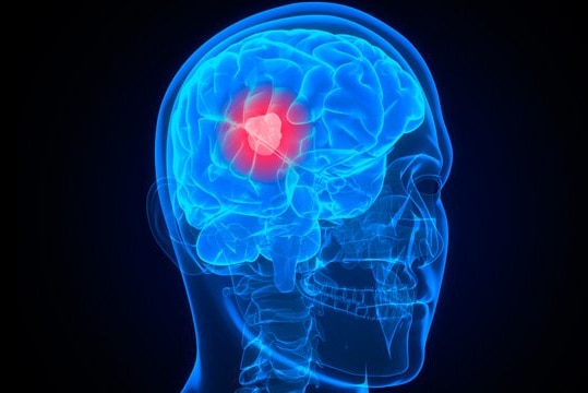 An x-ray type image showing a tumour inside a human brain.