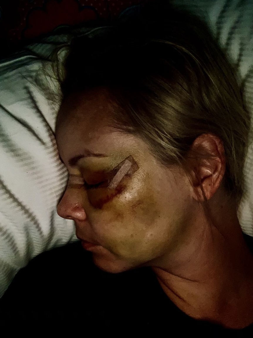 woman lying on white pillow turning her head to the left with a purple bruise on her eye