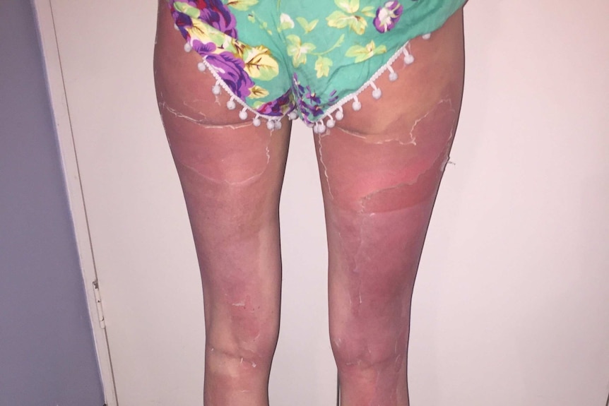 A woman's severely burned legs