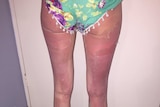 Leg sunburn