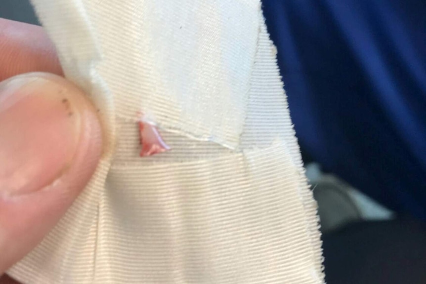 A shark's tooth found in the leg of a 13-year-old boy