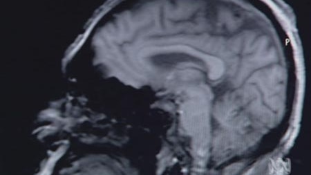 A scan of a human brain with multiple sclerosis