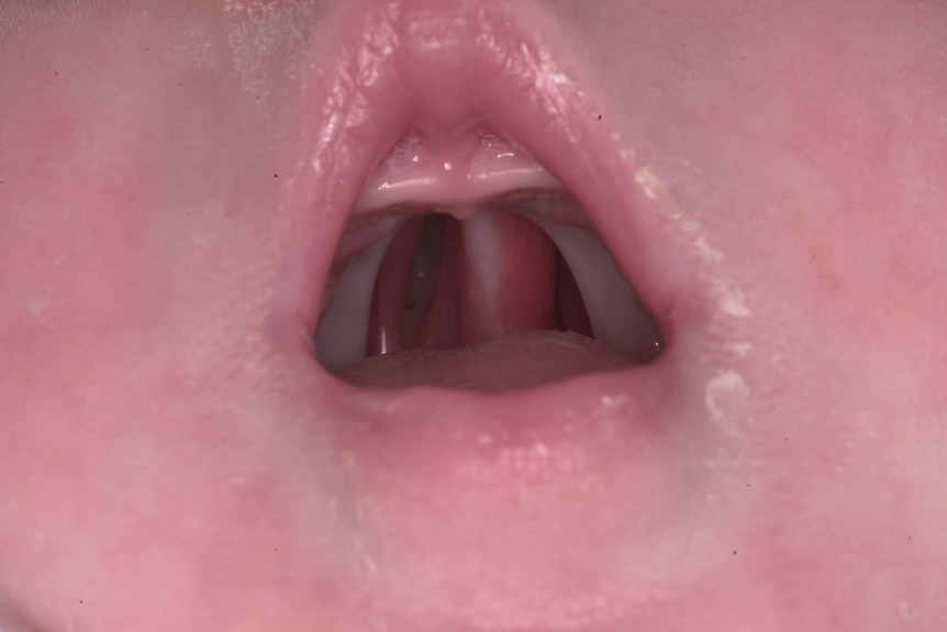 A photo of Emma Johnston's cleft palate from when she was a baby
