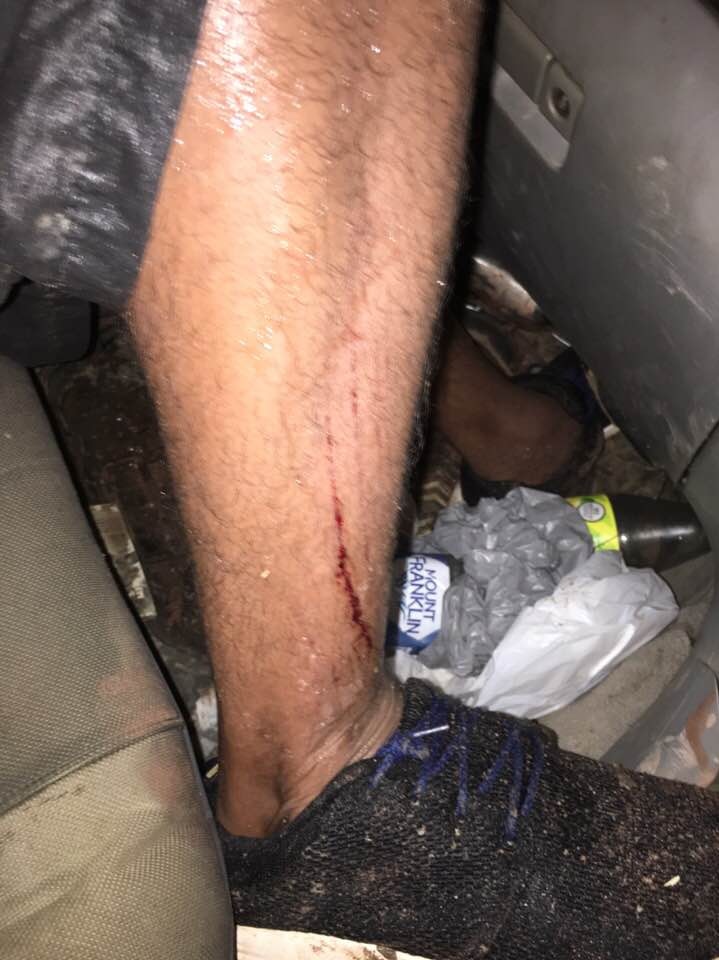 A man's leg with blood from a crocodile attack