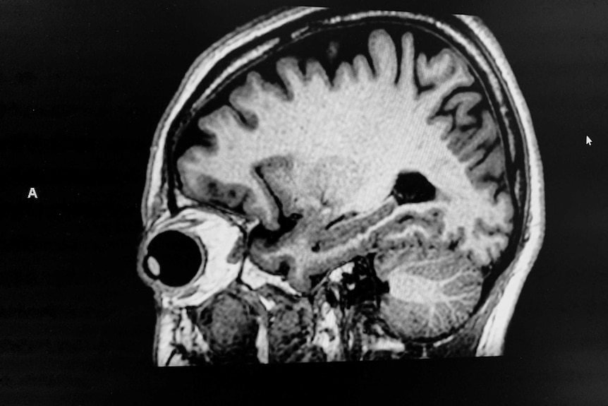 Brain scan from side of head