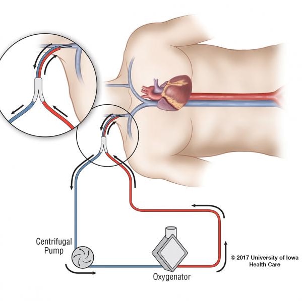 Veno-venous ECMO