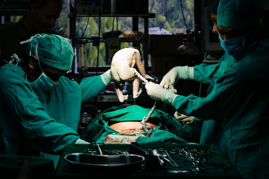 Two doctors stand on either side of a woman's stomach as they lift a baby from  her womb.