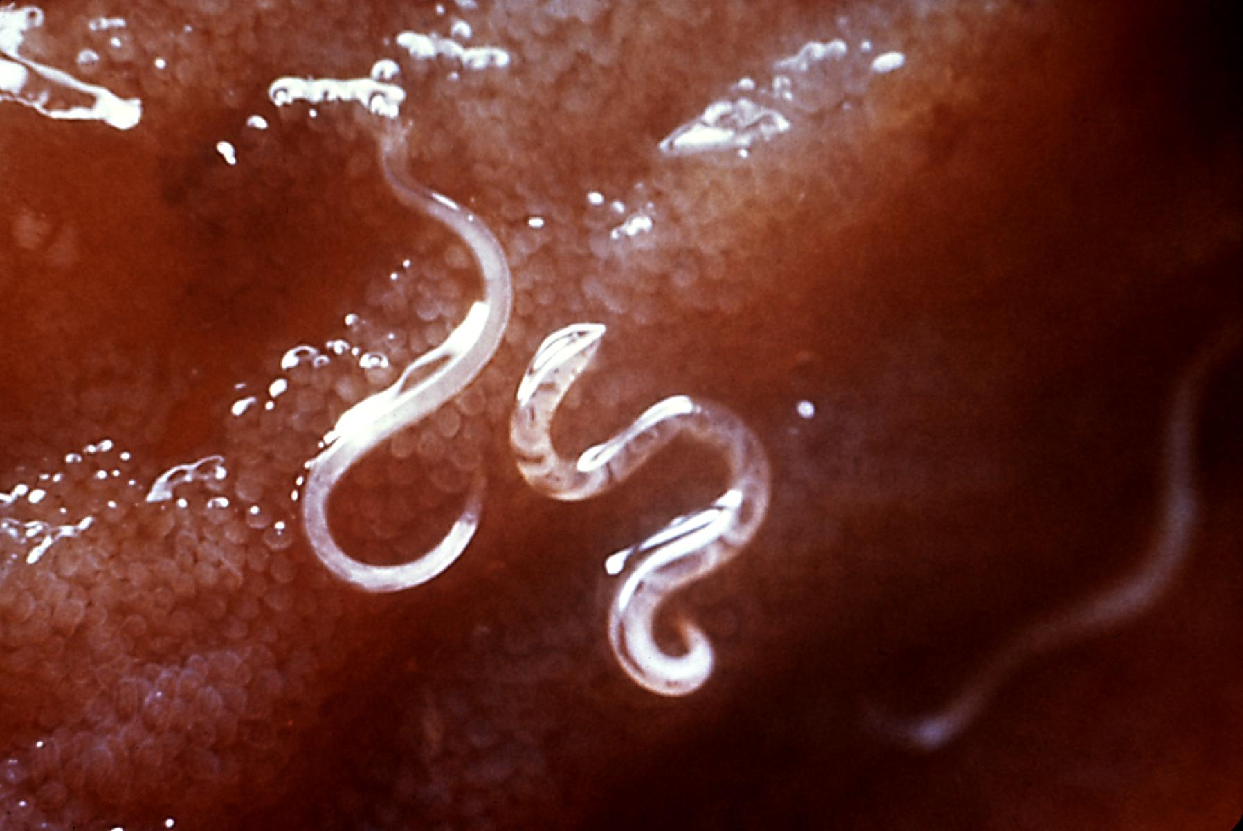 A hookworm is seen attached to the intestinal mucosa.