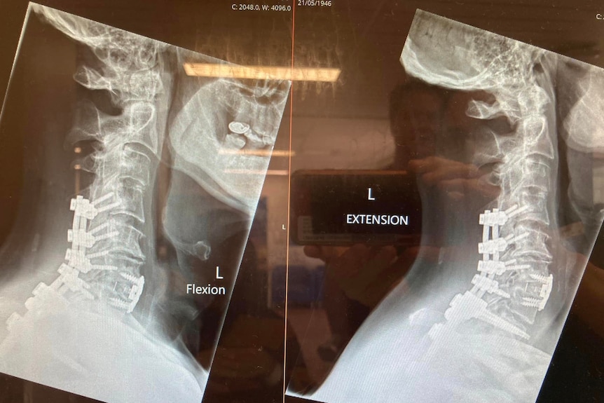 Medical imaging showing rods and pins inserted into spinal bones. 