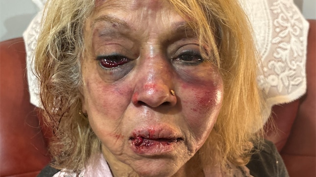 A graphic photo of an older woman with cuts on her face and severe bruising
