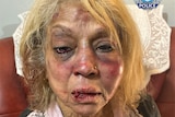 A graphic photo of an older woman with cuts on her face and severe bruising