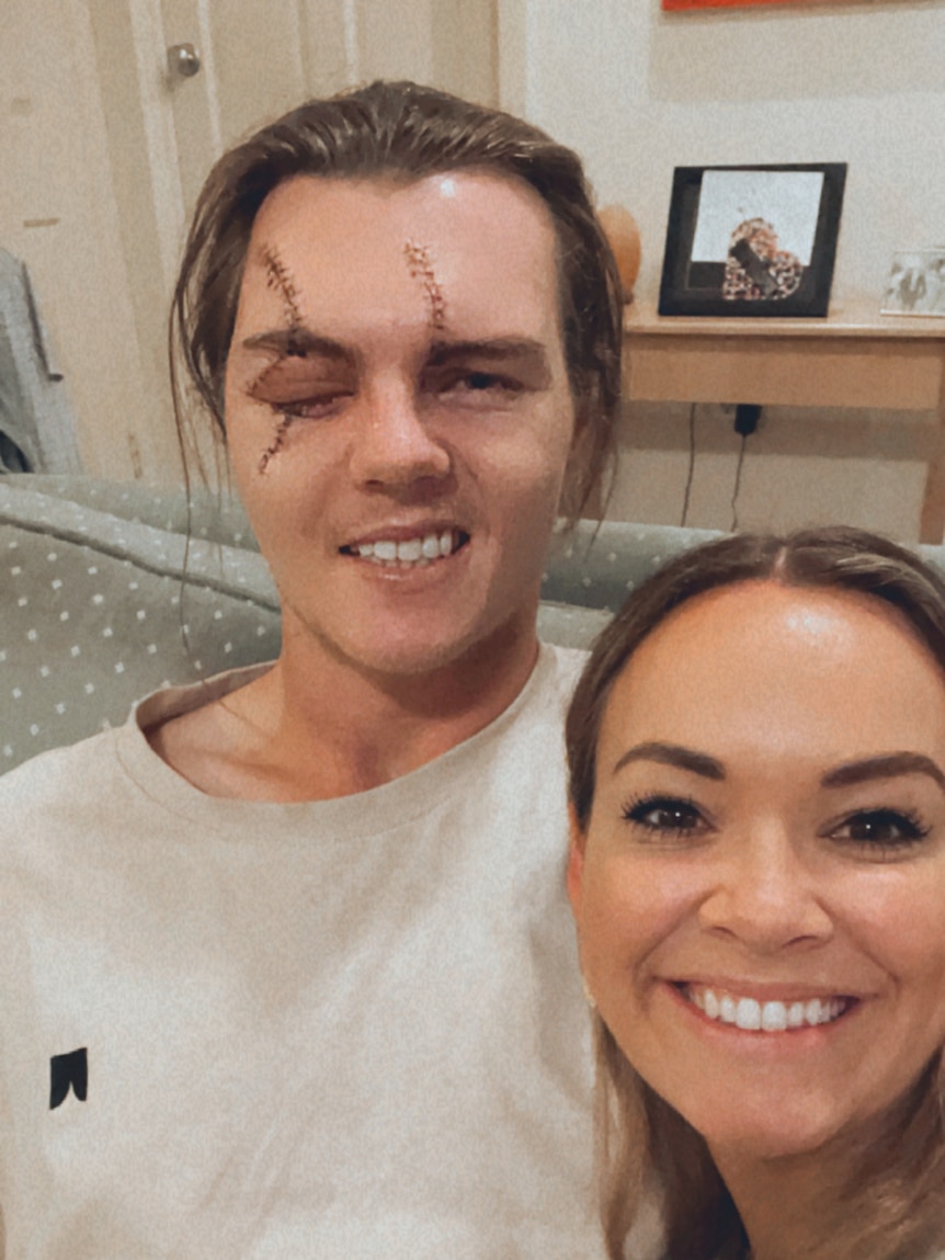 A close up of a man with two large scars over his eyes and a swollen left eye next to a woman, both are smiling