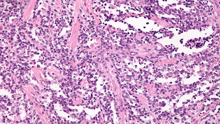 Cancerous cells stained pink.