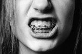 black and white photo of young woman grinning to reveal metal braces on her teeth