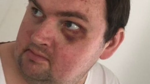 A headshot of a man in his 30s wearing a white t-shirt. He has a black eye and bruise-like blemish on his forehead.