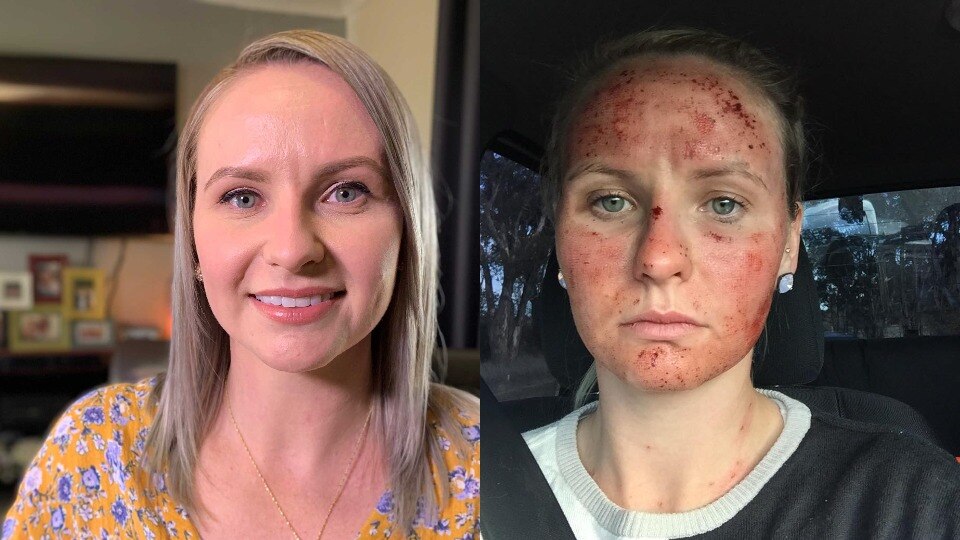 Composite image of a woman smiling and a woman looking sad with bleeding red marks on her face.