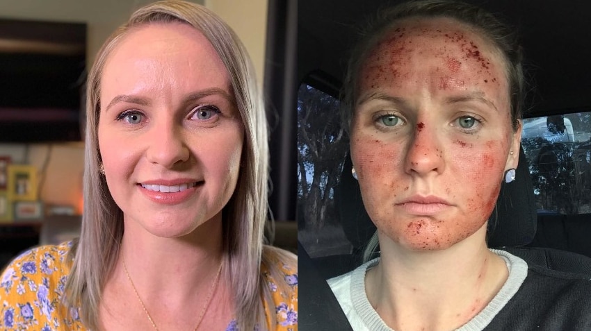 Composite image of a woman smiling and a woman looking sad with bleeding red marks on her face.