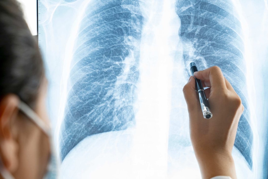 Doctor checking patient chest x-ray film at ward hospital.