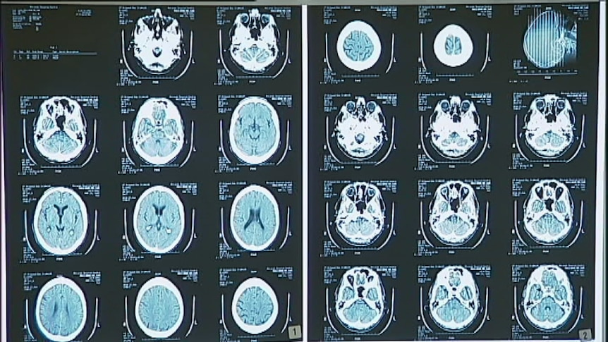 Dementia brain scans