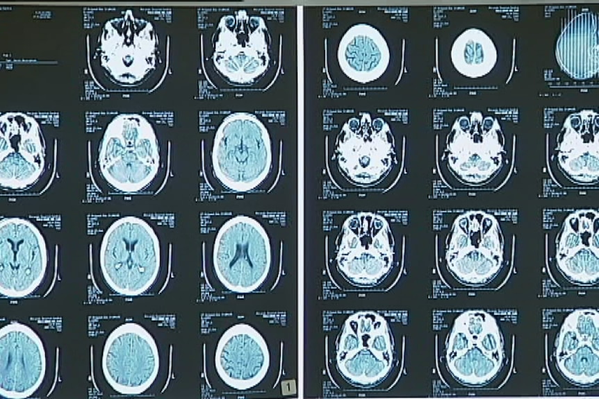 dementia scans