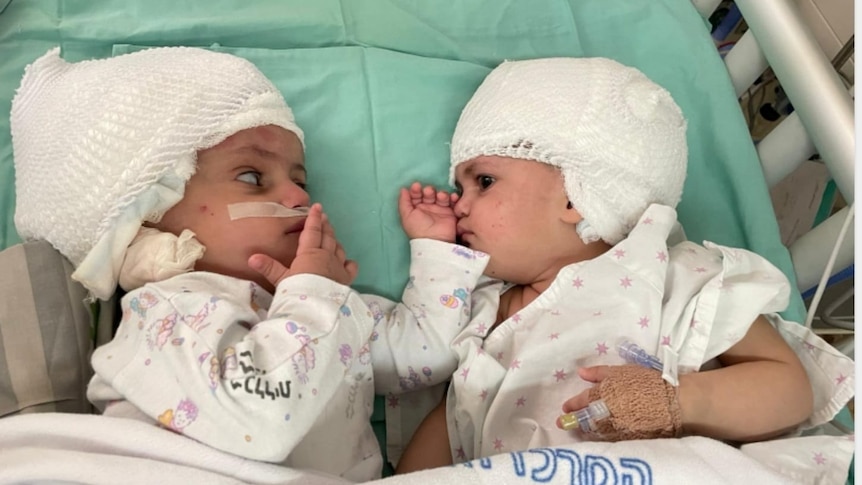 Conjoined twins open up about sex life   — Australia's leading  news site