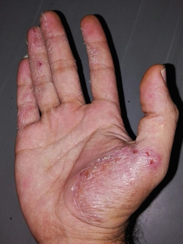 Benham Satar's hand flared up with skin condition
