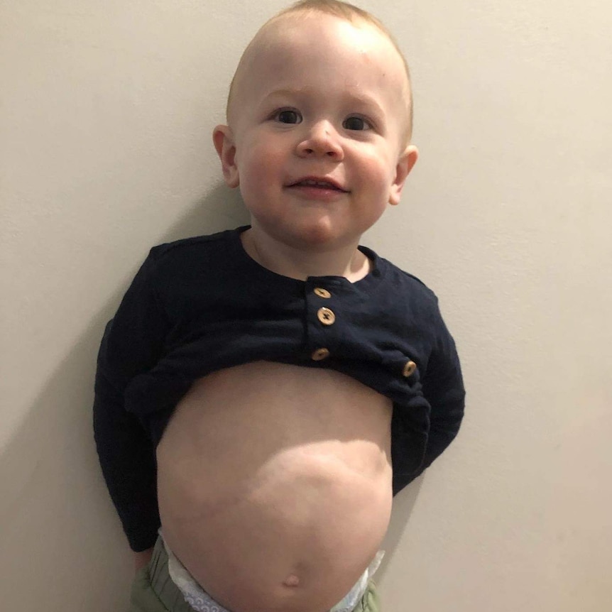A a 22-month-old boy poses for a photo with his shirt lifted to show a large surgical scar across his stomach.