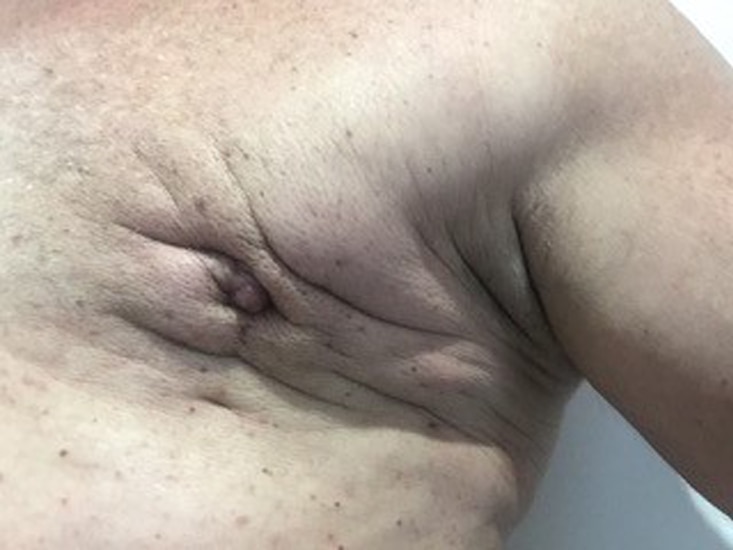 A man's nipple surrounded by creases of skin.