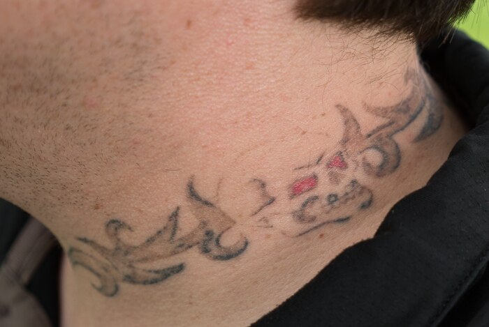 Clinton Trestrail tattoo after two laser treatments.