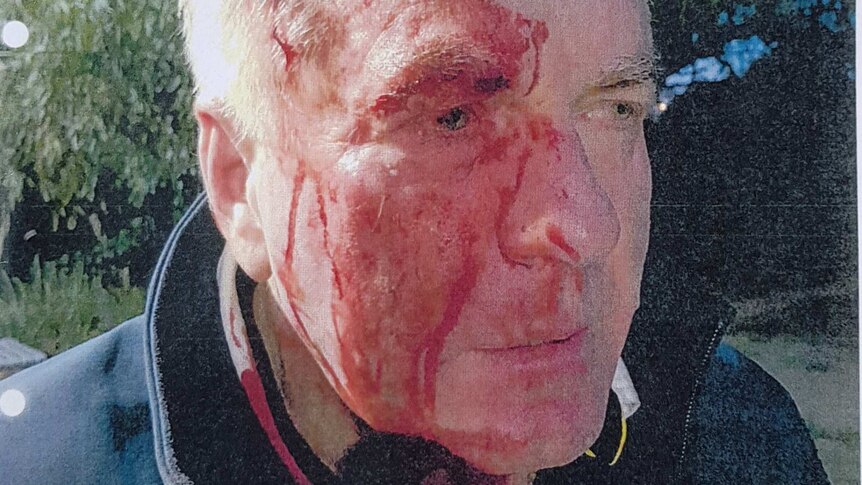 A picture of a man with blood pouring from his head, down the right side of his face and onto his neck and jumper.