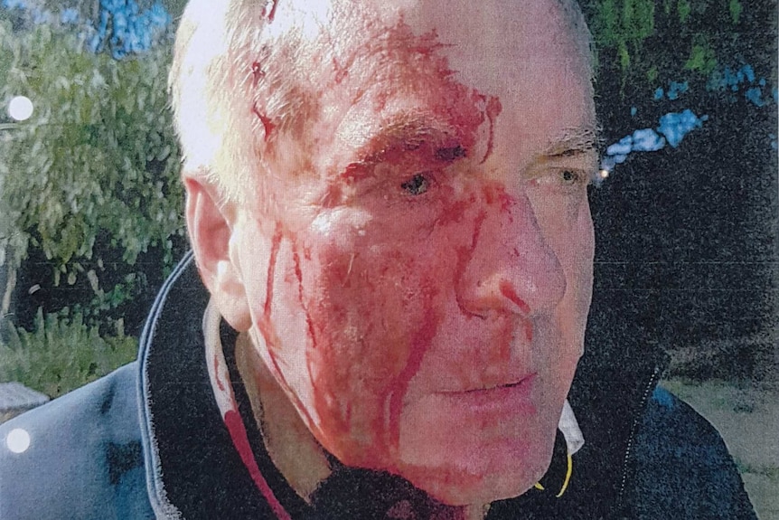 A picture of a man with blood pouring from his head, down the right side of his face and onto his neck and jumper.