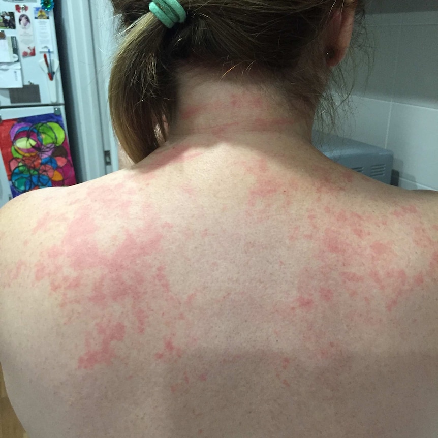 Robyn's back covered in a rash