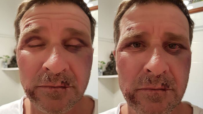 Two images side by side of a man's face, closeup. He has bruising on his left eye, and scrapes around his jaw.