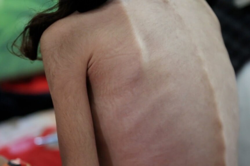 An emaciated child, seen from behind.