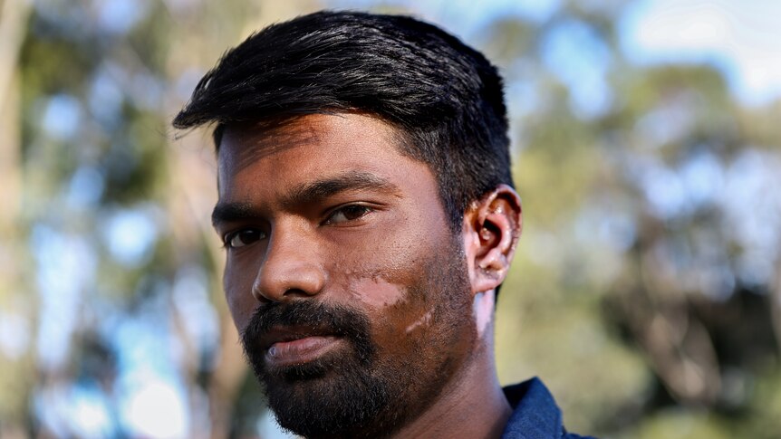 Man with skin visibly affected by burns on cheek and ear stares directly into camera, with trees and blue sky behind him.
