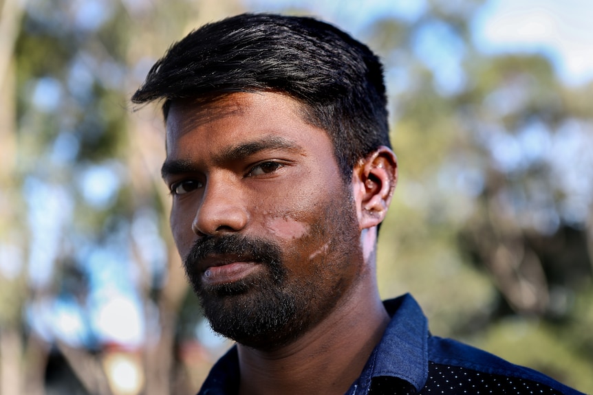 Man with skin visibly affected by burns on cheek and ear stares directly into camera, with trees and blue sky behind him.