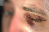 A close up of a police officer, whose face is blurred, with a black eye.