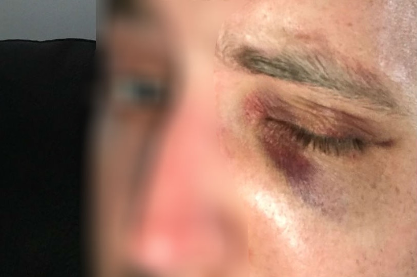 A close up of a police officer, whose face is blurred, with a black eye.