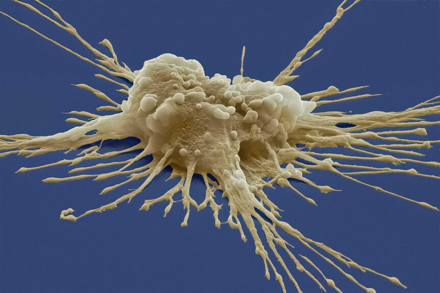 A coloured scanning electron micrograph of a pluripotent stem cell derived from a white blood cell.