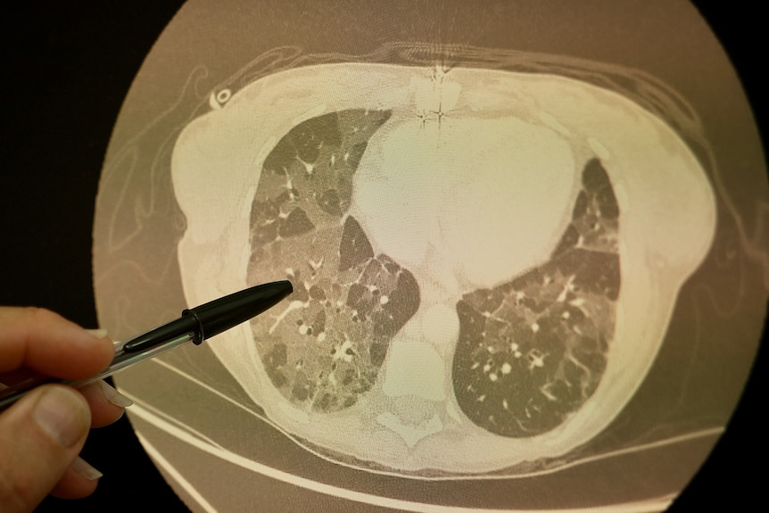 A scan showing how cystic fibrosis has damaged Tina's lungs