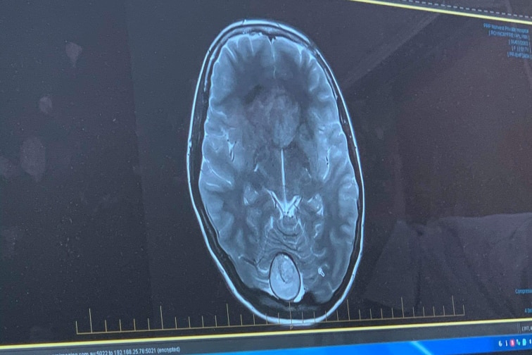 A scan of the tumour inside a brain