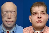 Patrick Hardison before facial surgery (left) and nearly three months after the surgery in November 2015.