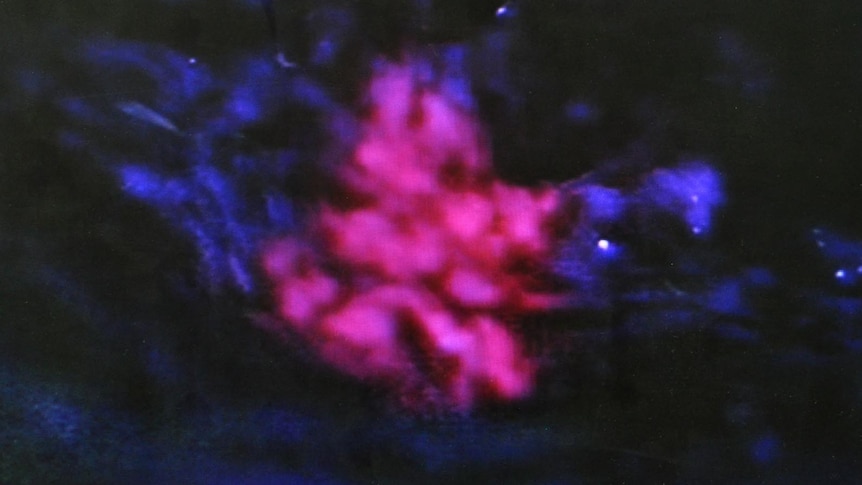 The drug makes the cells of the tumour glow under the blue light of an operating microscope.