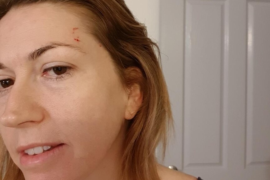 Close-up indoor selfie of a woman showing a bitemark on the her left side of her forehead.