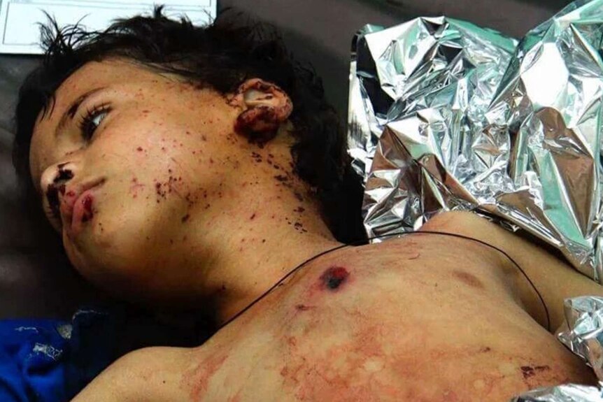 Child lying on the bed with injuries to his face and body