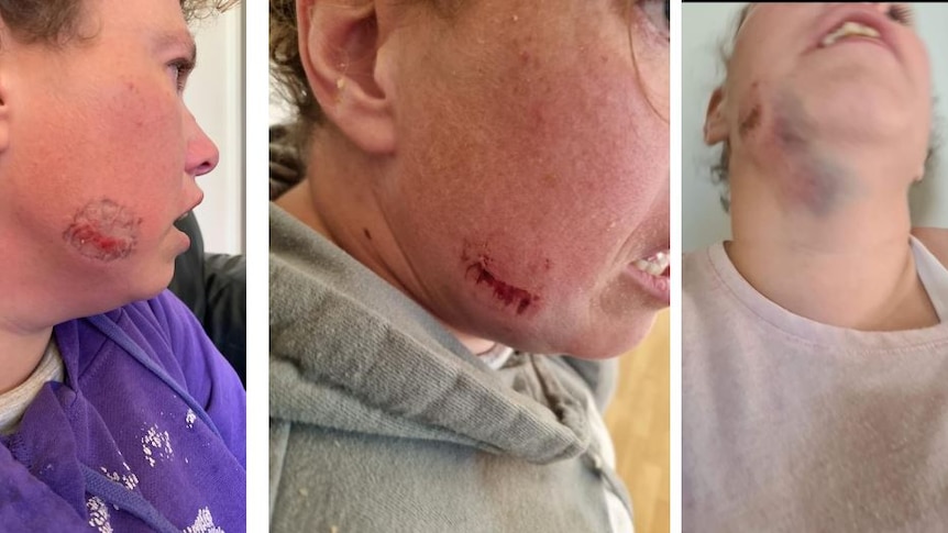 Three images of a young woman. Two show a bite mark to her cheek, the other shows bruising to her neck.