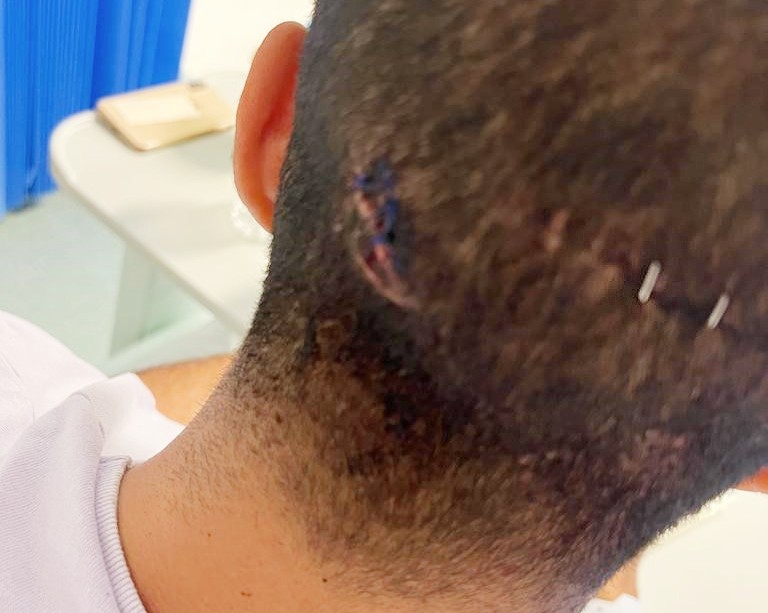 Stitches in the victim's head.